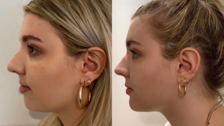 chin filler before and after comparison