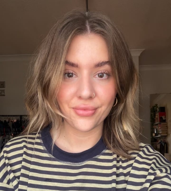 chin filler results after four years